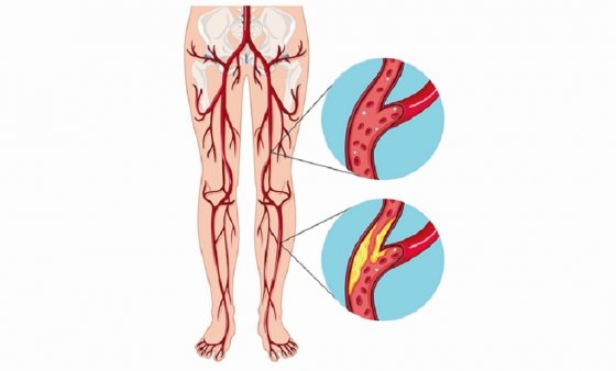 Periferik damar xəstəliklərində müdaxilələr