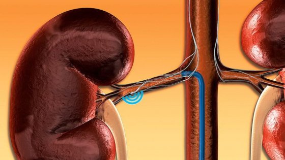 Renal denervasiya Renal denervasiya