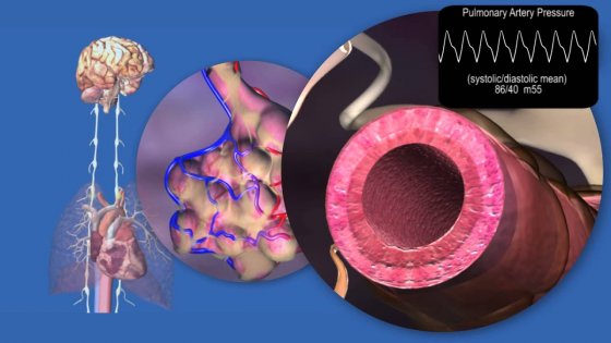 Pulmonar arteriya denervasiyası