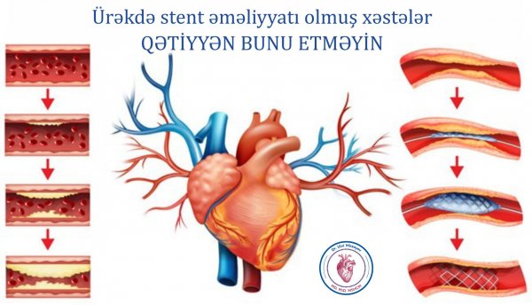 Ürəkdə stent əməliyyatı olmuş xəstələr qətiyyən bunu etməyin